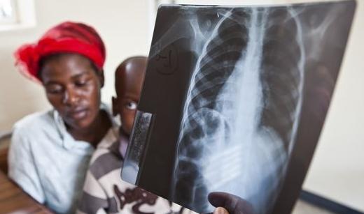 Qual sintoma de tuberculose em crianças é considerado o início da doença?