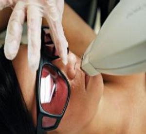 Depilação a laser do lábio superior: um procedimento eficaz na luta contra os cabelos entediados