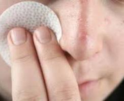 As causas da acne no rosto e como se livrar delas